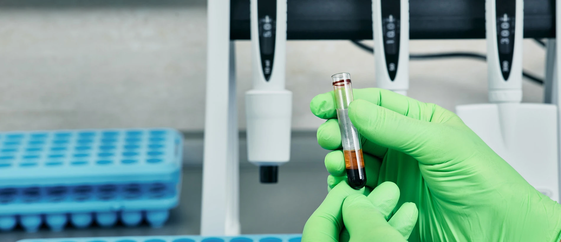 Железодефицитная анемия - TOP Clinic DENIS