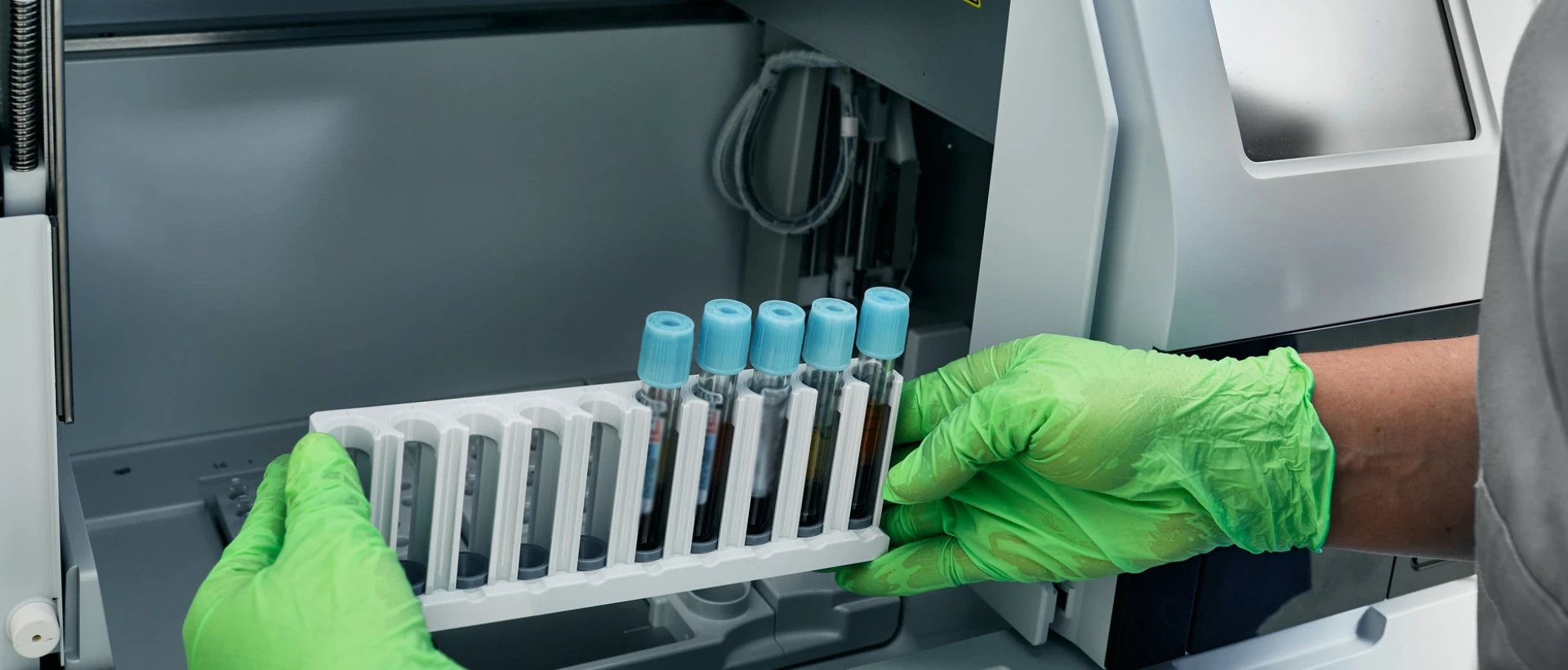 Фолієводефiцитна анемія - TOP Clinic DENIS