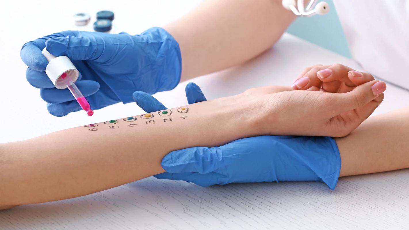 Прик-тесты (кожные аллергопробы) - TOP Clinic DENIS